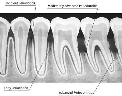 Perfect Smile radiographic progression of periodontal disease
